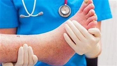 علاج التهاب اعصاب القدم لمرضى السكري