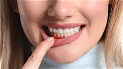 اسباب ڼزيف اللثة وعلاجه اثناء غسل الاسنان 